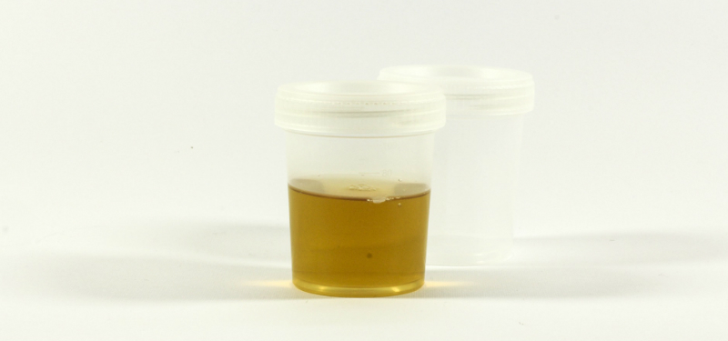 darker urine due to vitamins dark urine